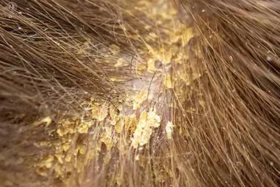 Nguyên nhân phát sinh gàu ướt là gì? Cách chăm sóc tóc đúng cách 