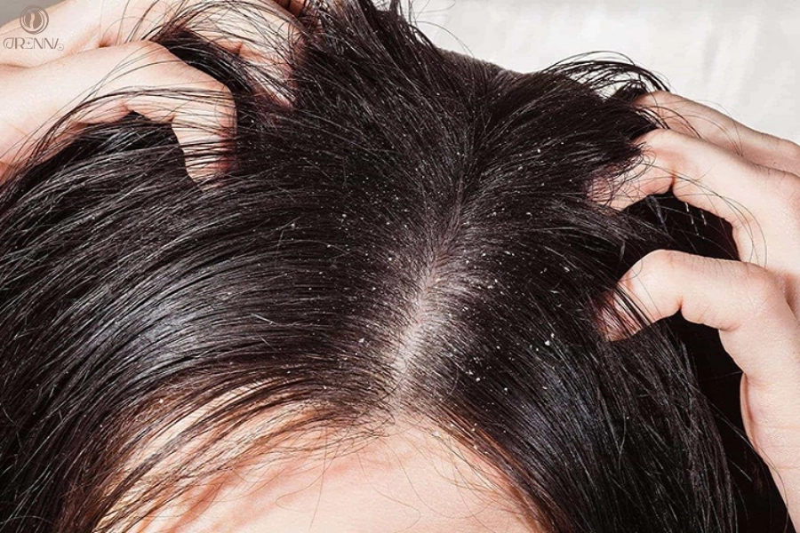 10 Cách Chăm Sóc Da Đầu Yếu Hiệu Quả, An Toàn Tại Nhà