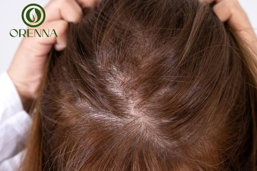 Nguyên Nhân Tóc Mỏng Yếu Và Giải Pháp Khắc Phục Hiệu Quả 