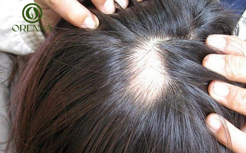 Phòng ngừa hói đỉnh đầu ở nữ và lời khuyên từ chuyên gia