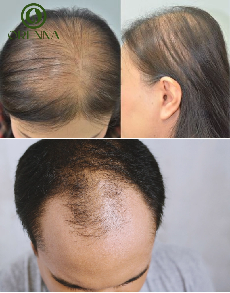 Nguyên nhân gây rụng tóc và hói đầu phổ biến