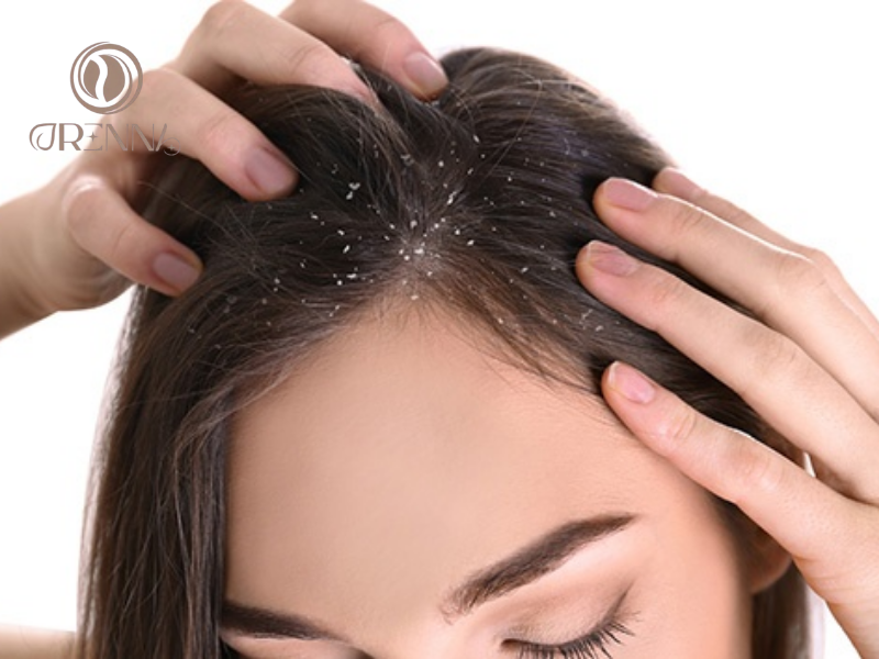 Bị gàu có nên gội đầu nhiều không và tại sao?