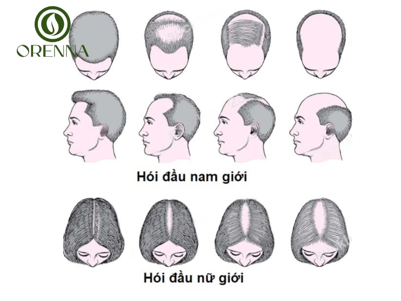 Dấu hiệu nhận biết và các kiểu hói phổ biến