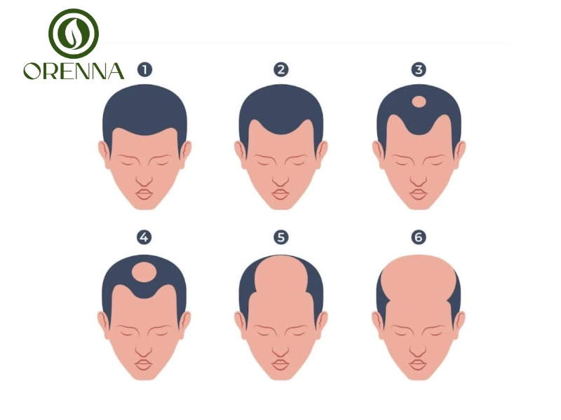 Các nguyên nhân chính gây hói đỉnh đầu