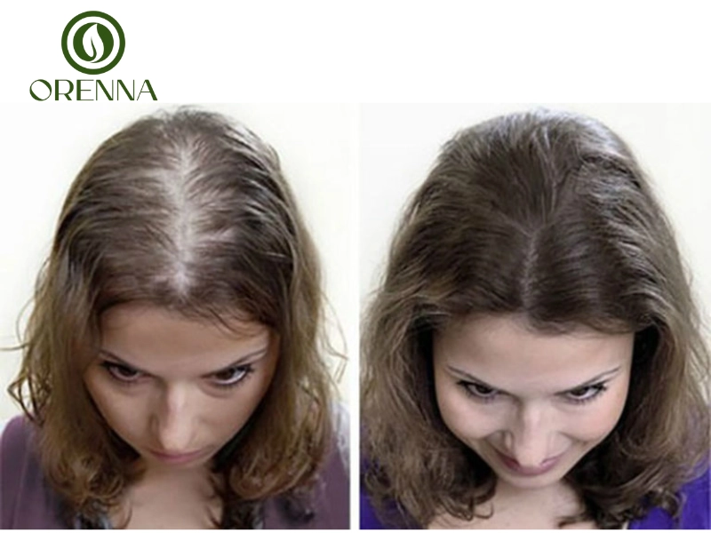 Các giải pháp khắc phục hói đỉnh đầu ở nữ hiệu quả