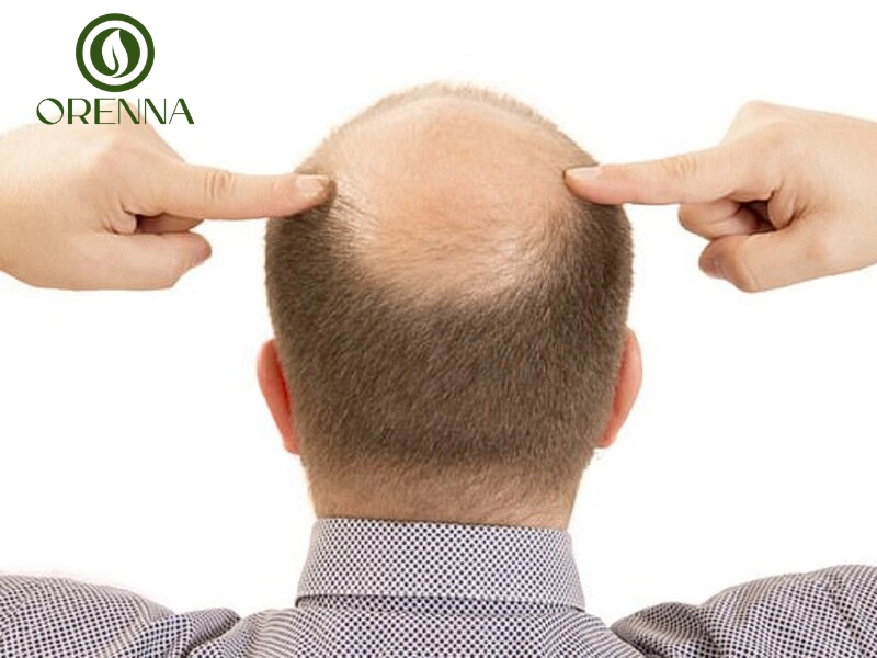 Hói đầu là tình trạng rụng tóc vượt quá mức sinh lý bình thường